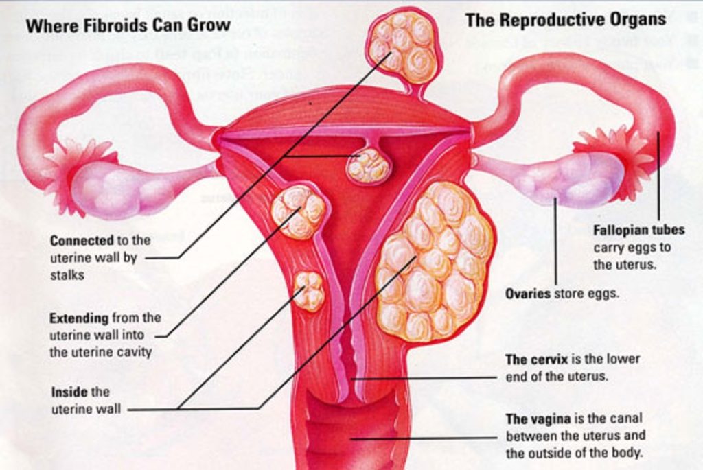 Types of Fibroids