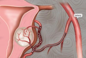 hysterectomy alternative