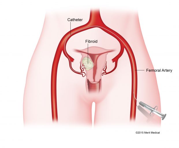 Medical illustration of uterine fibroid embolization