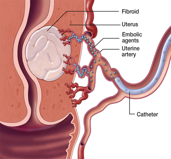 Uterine fibroid embolization medical illustration