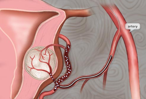 Medical illustration related to uterine fibroid care
